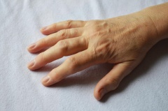 Артрит пальцев рук - причины, симптомы, лечение и профилактика